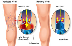 Varicose Veins