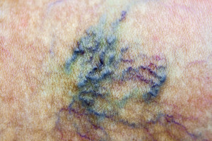 Varicose vein. Macro. Spider vein. Woman skin