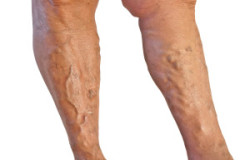 Varicose Veins