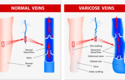 Varicose vein