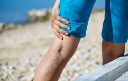 Painful Varicose Veins