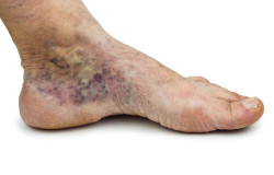 Varicose Vein