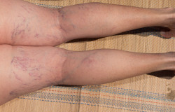 Painful Varicose And Spider Veins