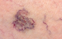 Close-up Of Skin With Varicose Veins