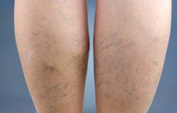 Varicose Veins