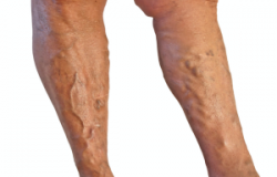 Varicose-Veins-300x200